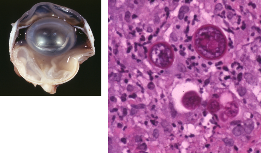 <ul><li><p><strong>pyogranulomatous chorioretinitis</strong></p></li><li><p>primarily pulmonary infections; may disseminate: long bones, heart, CNS, eyes</p></li><li><p>round spherules, filled with small endospores</p></li></ul><p></p>