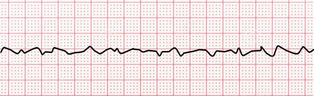 <p>Which cardiac arrest rhythm is shown here?</p>