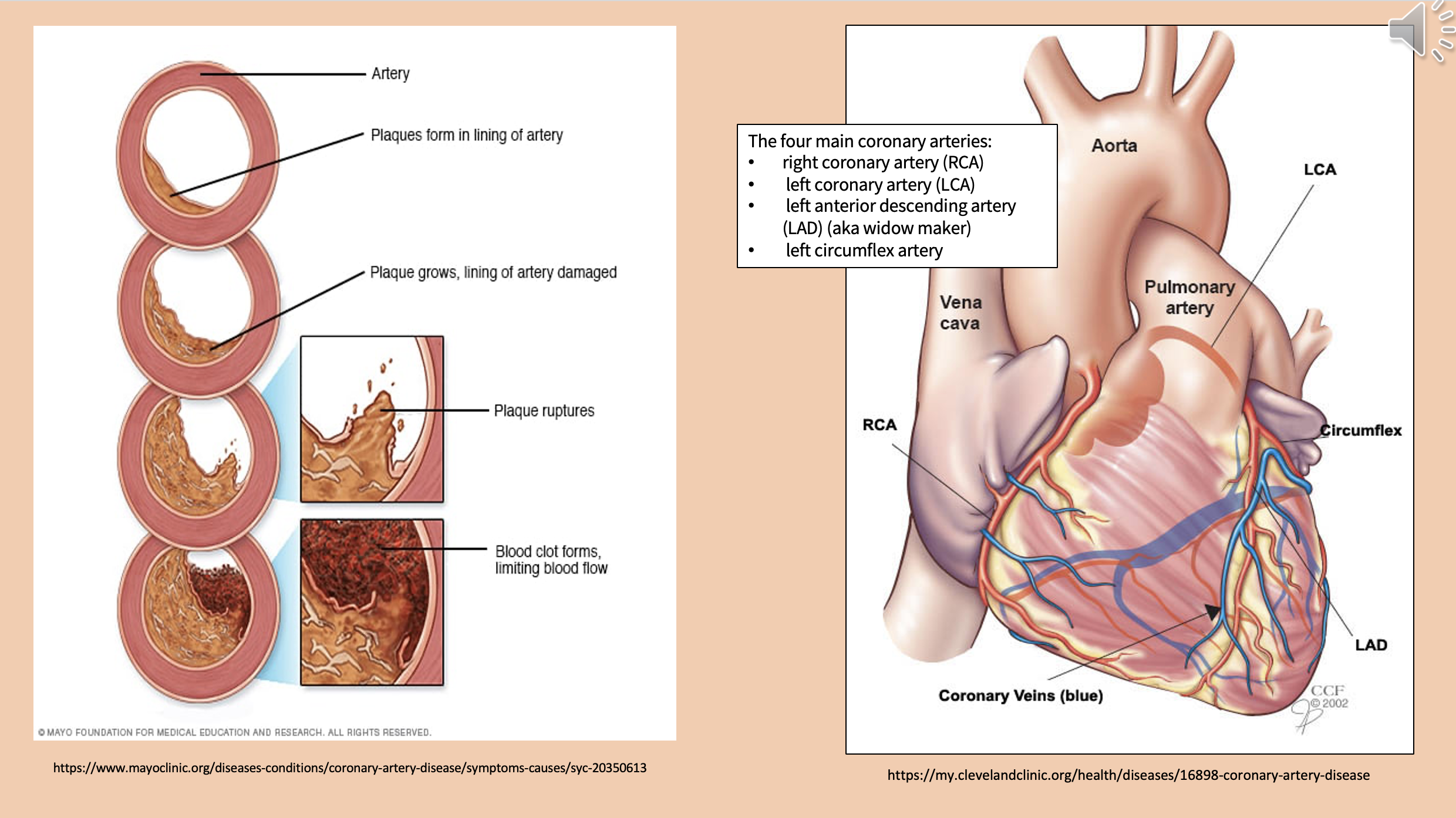 <p><span>left anterior descending artery</span></p>