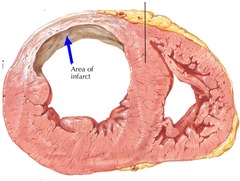 <p>This old infarct is located in</p>
