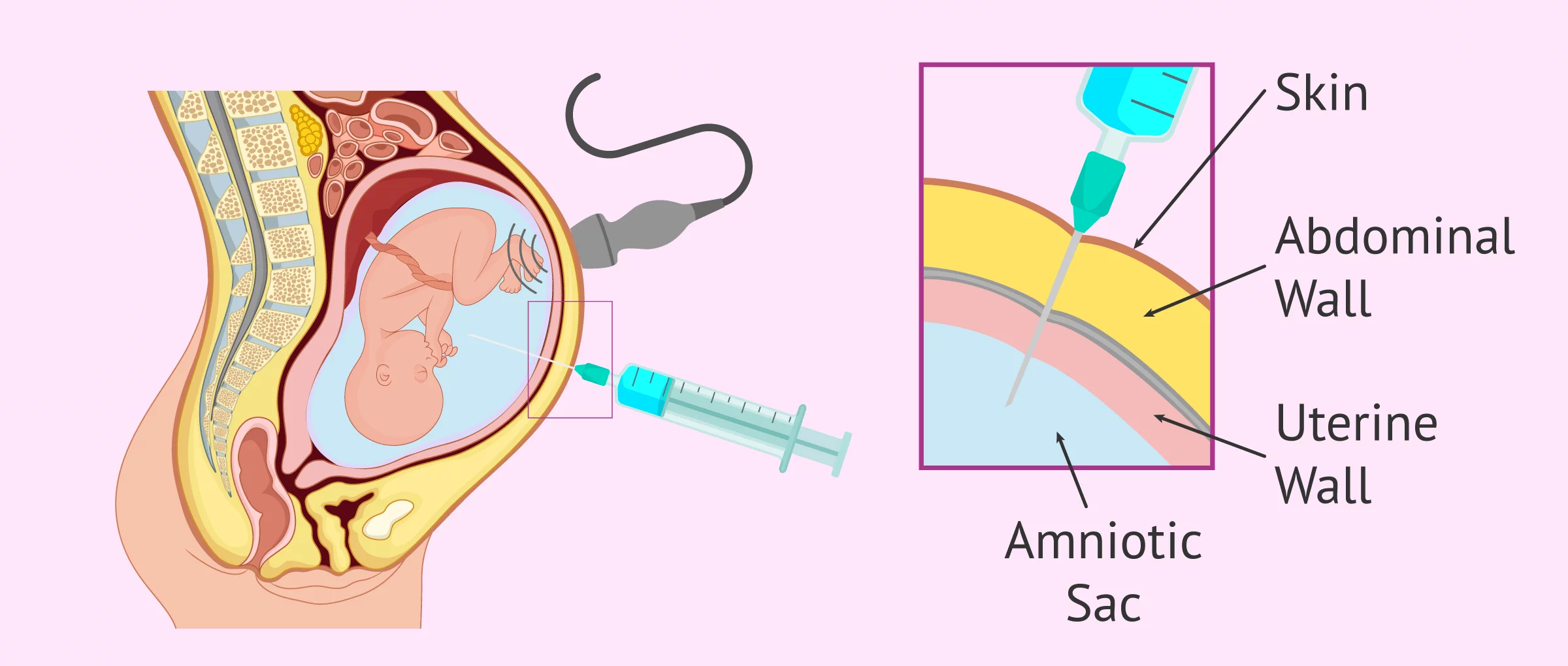 <p>amniocenteza</p>