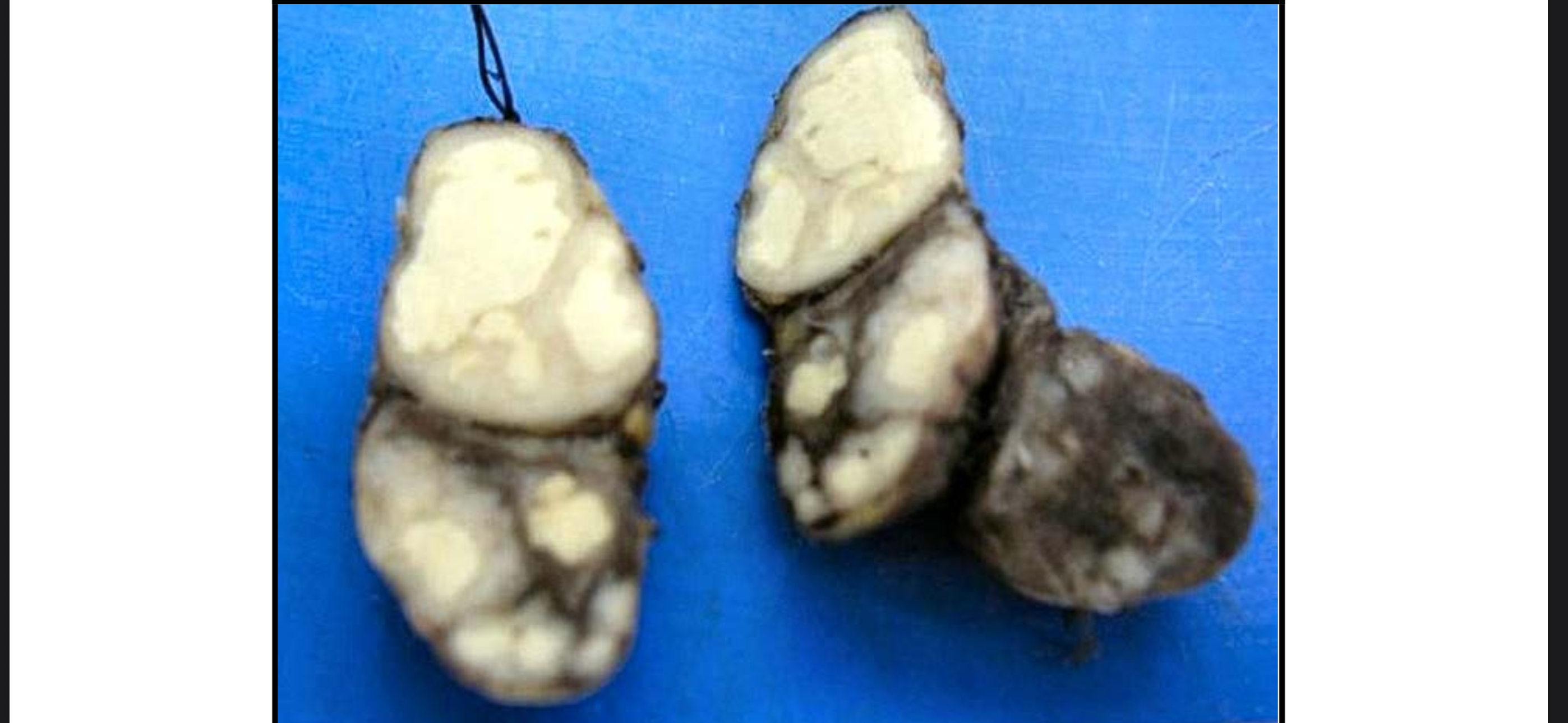 <p>Bệnh lý gì</p>