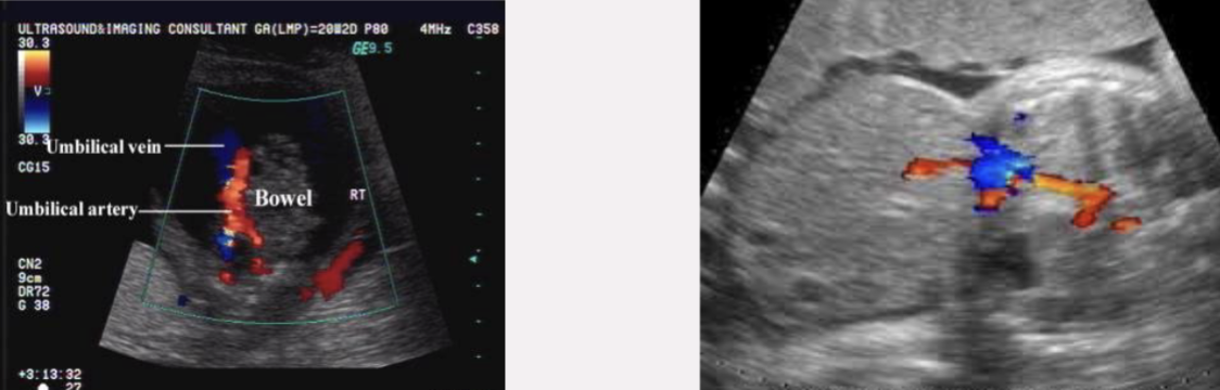 <p>which is omphalocele? which is gastroschisis?</p>