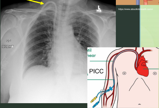<ul><li><p>Rapid infusion of fluids, nutrition, drugs, dialysis over a long period of time.</p></li><li><p>Measures central venous pressure (CVP)</p></li><li><p>Placement in internal jugular vein, subclavian vein, and common femoral vein.</p></li></ul><p></p>