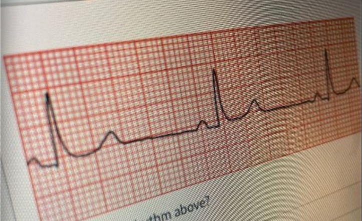 <p>i. Ventricular fibrillation</p><p>ii. Supraventricular tachycardia</p><p>iii. Bradycardia sinus rhythm</p><p>iv. Normal sinus rhythm</p>