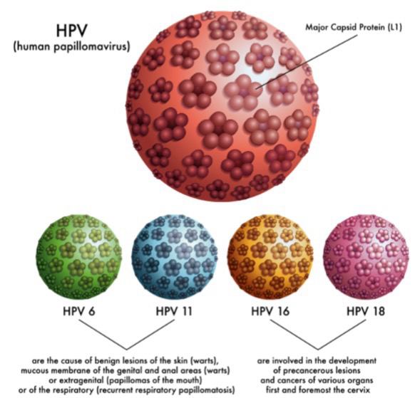 <p>Most human cancers are NOT communicable diseases; <strong>Human Papilloma Virus (HVP) </strong>is the exception; Most common STD; HPV 16 and 18 cause cancer, HPV 6 and 11 cause milder non-cancerous symptoms</p><p>Papanicolaou (“Pap”) test involves scraping cells from the cervical wall, mounting and staining for microscoping examination</p><p>Pre-cancerous cells have large nucleus because more replication is occurring</p>