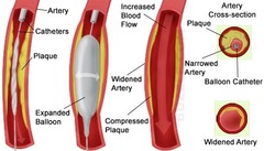 <p>Surgical repair of a vessel</p>