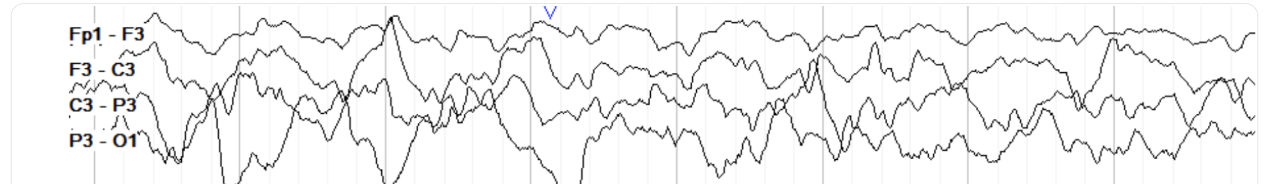 <p>high amp, delta, synchronized</p>