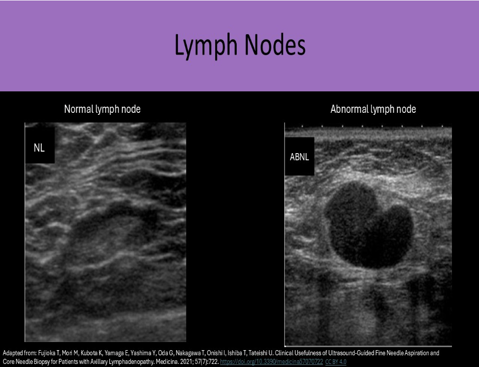 <p>D. normal lymph node</p><p>Normal lymph nodes are ovoid in shape. They do not demonstrate posterior enhancement. As lymph nodes enlarge with abnormal fluid accumulation, they appear more rounded and hypoechoic/anechoic. The "plump" cortex causes decreased visualization of the central hilum. Color Doppler can be used to locate the hilum and main vascular supply. Posterior enhancement is present in structures posterior to abnormal nodes with significant fluid accumulation.</p>
