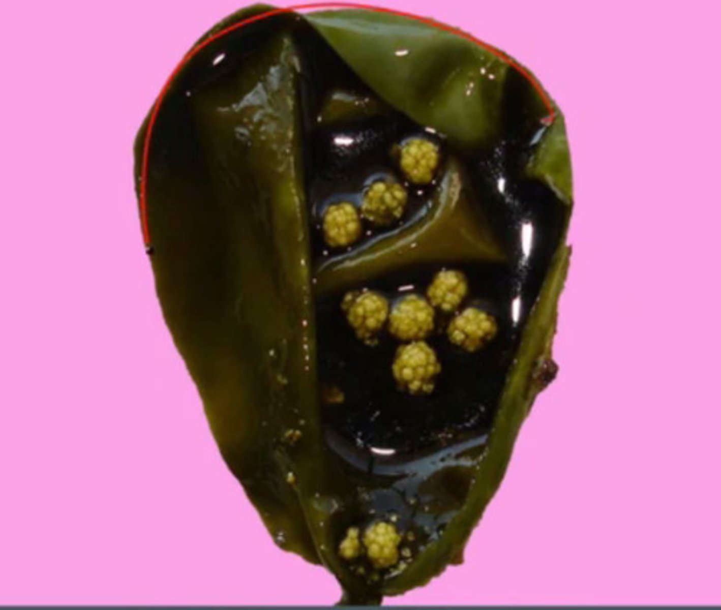 <p>cholelithiasis</p>