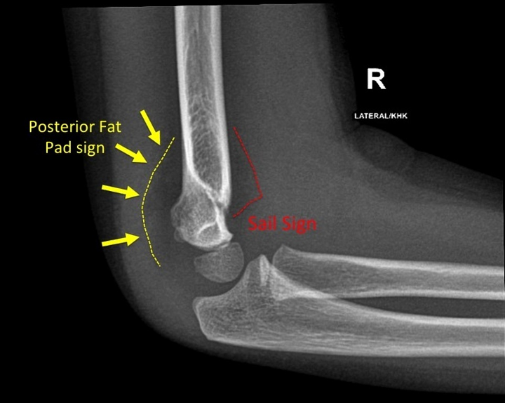 <ul><li><p>Suggests the presence of an occult fracture of the elbow </p><ul><li><p>Anterior fat pad → often normal</p></li><li><p>Posterior fat pad → always abnormal → consider CT/MRI</p></li></ul></li></ul><p></p><p></p>
