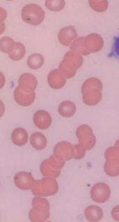 <p>What red cell distribution is this?</p>