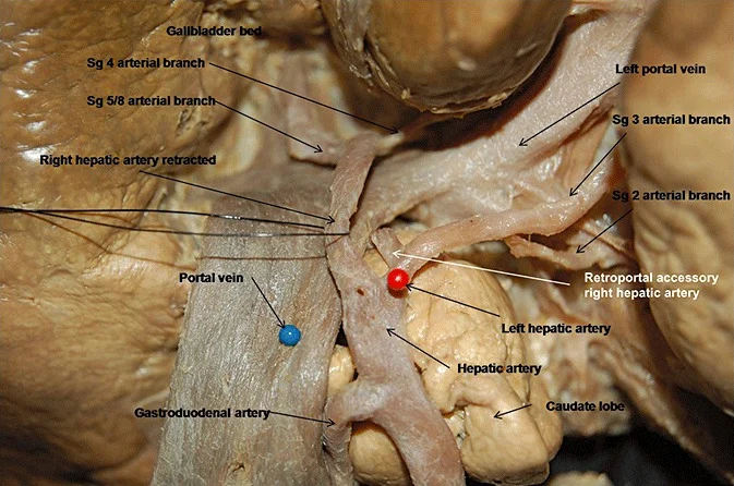 <p>right below the common hepatic artery, but split in half kina</p>