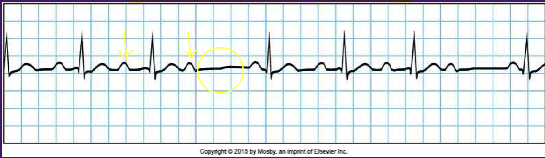 <p>Heart block - 2nd degree type 1 (Wenckenbach/Mobitz 1)</p>