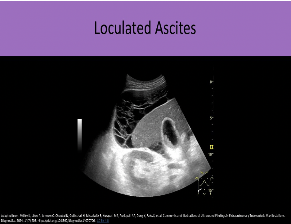<p>D. ascites with debis/septations</p><p>Ascites is a common finding with abdominal viral or bacterial infections.</p><p class="p1">Bleeding of the intraperitoneal organs also causes ascites. Ascites may appear complex and contain debris/septations if there is associated bacterial infection, internal bleeding, or viral infection. Abscess formation may be seen with the infections, but is not typically associated with internal bleeding.</p>