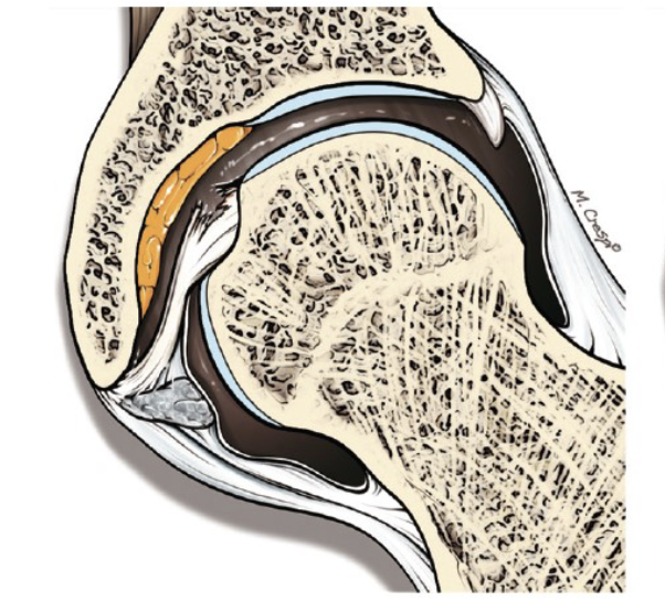 <p>What condition of the ligamentum teres is shown</p>