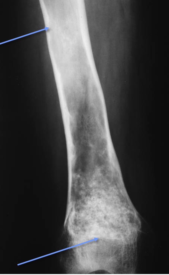 <p>What tumour like disorder is this, what can you see?</p>
