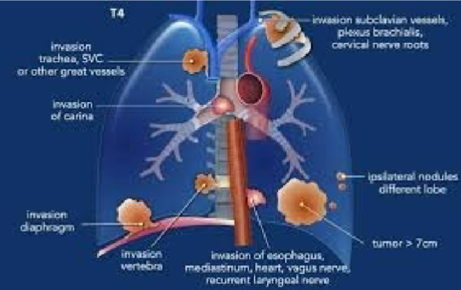 <p><strong><u>>7 cm</u></strong></p><p>OR invading:</p><ul><li><p>Diaphragm</p></li><li><p>Mediastinum</p></li><li><p>Heart</p></li><li><p>Vagus nerve</p></li><li><p>Great vessels</p></li><li><p>SVC</p></li><li><p>Trachea</p></li><li><p>Recurrent laryngeal nerve</p></li><li><p>Esophagus</p></li><li><p>Vertebral body</p></li><li><p>Carina</p></li><li><p>Subclavian vessels, plexus brachialis, cervical nerve roots</p></li></ul><p>OR separate tumor nodule(s) in a <strong><u>different ipsilateral lobe</u></strong></p>