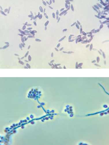 <p>Causes: rose gardenerās disease</p><p>Small cigar shaped yeasts, branches and bushels of flowers hyphae</p>