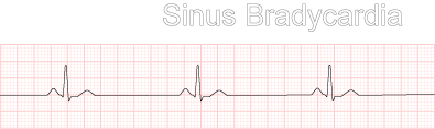 <p>What is this rhythm?</p>