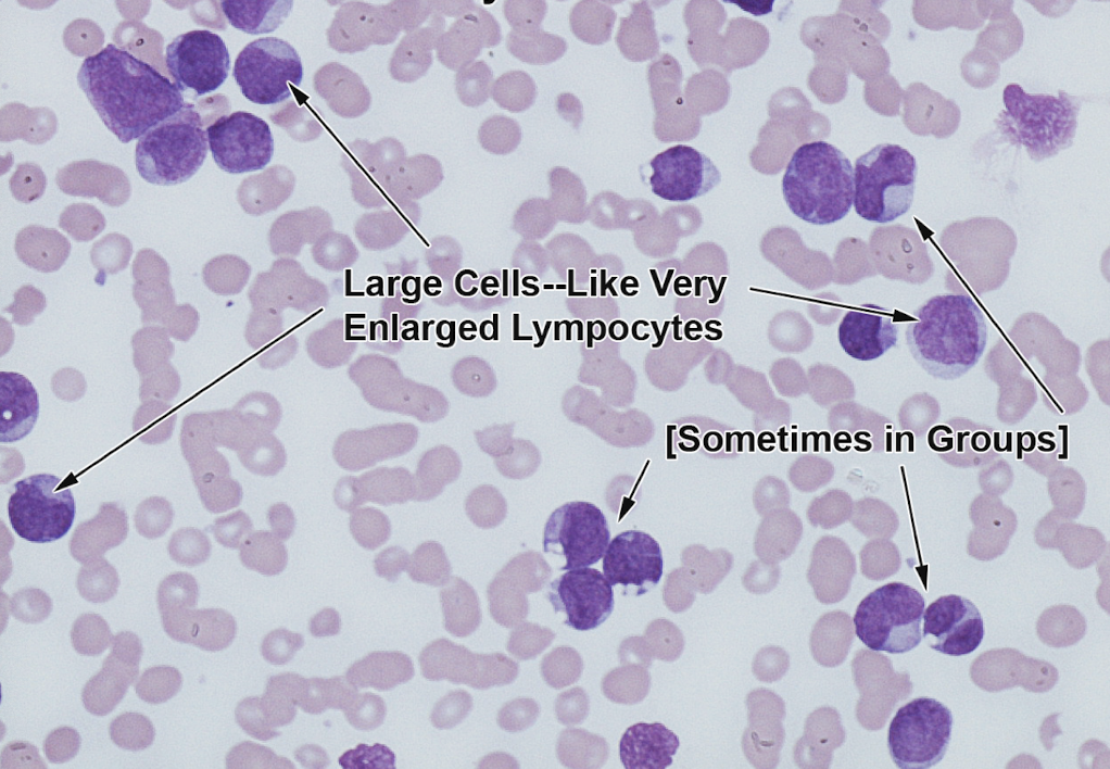 <p><span style="line-height: 19.55px;">Myeloblastic<strong> </strong>Leukemia</span></p>