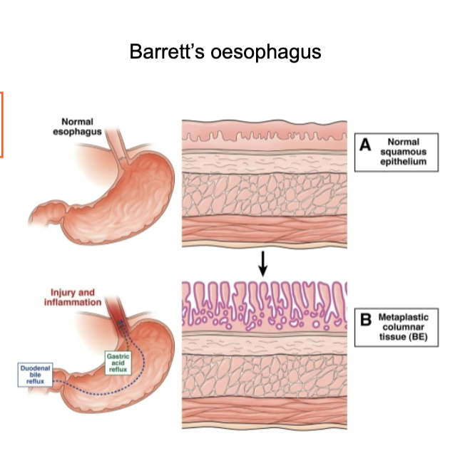 <ul><li><p>Caused by <strong>chronic acid reflux (GERD)</strong> → <strong>injury and inflammation</strong></p></li><li><p>Normal <strong>squamous epithelium transforms to columnar epithelium</strong> (metaplasia)</p></li><li><p>Represents <strong>exposure-driven EMT / phenotype switching</strong></p></li><li><p>Acts as a <strong>precursor to oesophageal adenocarcinoma</strong></p></li><li><p>Key feature: <strong>transition from squamous → columnar epithelium</strong> → important for diagnosis and risk monitoring</p></li></ul><p></p>