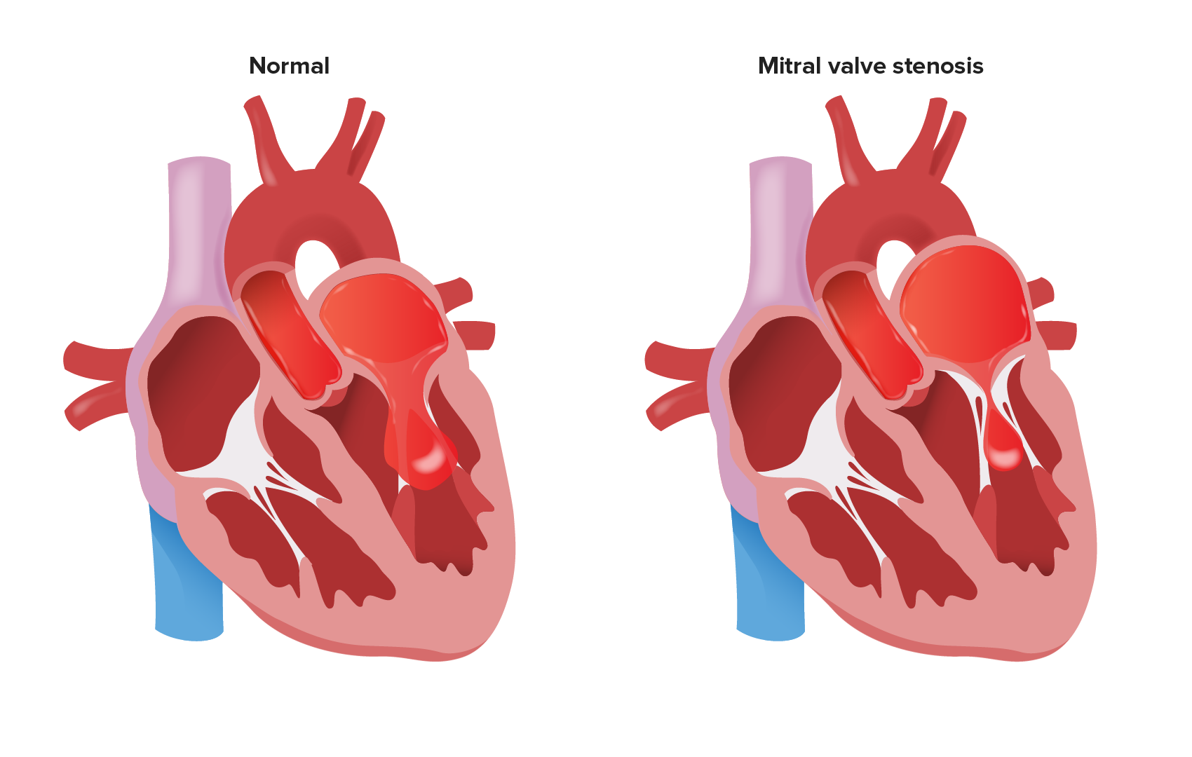 <p><strong>Mitral valve leaflets fuse/stiffen &amp; the chordae tendineae contract/shorten…</strong></p><p>i.) Most commonly caused by rheumatic fever/carditis </p><p>ii.) L atrial pressure rises → pulmonary artery pressure elevates → R ventricle hypertrophies </p><p>iii.) Pulmonary congestion &amp; R-sided HF occur first → preload ↓ &amp; CO falls</p>