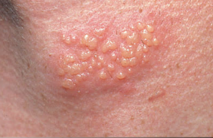 <p>Primary lesion - vesicle </p>
