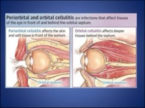 <p>Periorbital cellulitis affects the eyelid and surrounding skin, while orbital cellulitis involves the eye socket and can lead to vision impairment and complications. pain with eye movement / ophthalmoplegia + proptosis+ vision effect</p>