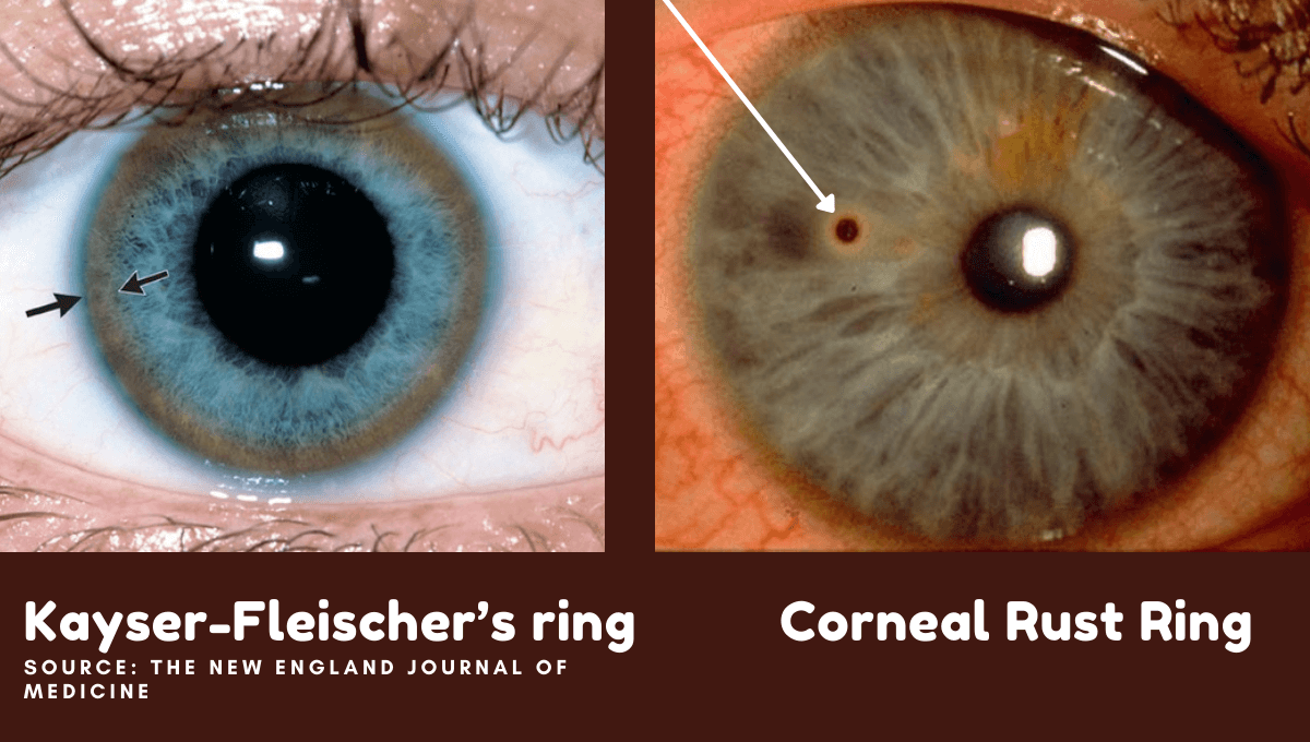 <p>greenish-brown deposits of copper in the cornea, associated with Wilson's disease, indicating copper accumulation in the body. </p>