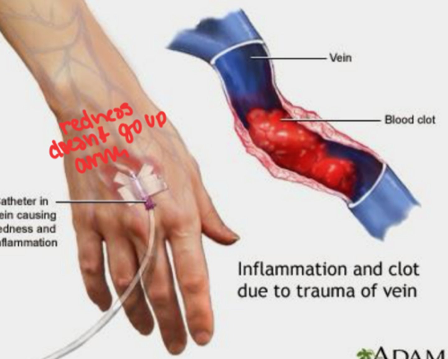 <p>The formation of blood clots within a vein (stationary clot)</p>