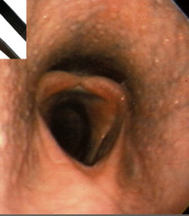 <p>You watch a racehorse "choke down" or falter at the end of a race. His cheeks bulge and he is coughing. The owner is mad because the horse has *expiratory* noise and feels like this is limiting the horses performance. What is happening?</p>
