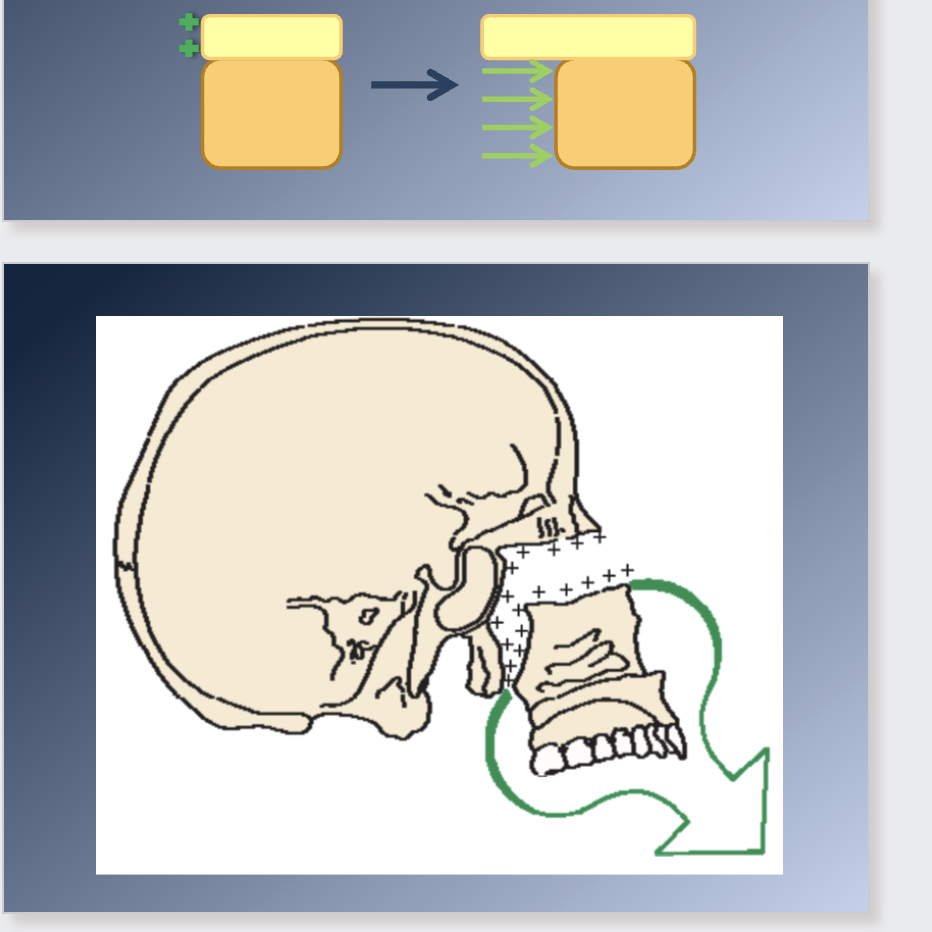 <p><span>2. Postnatal development:</span><br><span>1. Apposition of bones at the sutures that connect the maxilla to the cranium and cranial base.</span><br><span>2. Surface remodeling: dramatic surface changes.</span><br><span>3. Moved forward by growth of the cranial base</span><br></p><p><span> Maxilla should “grow out” from under the cranium</span><br><span>1. Pushed from behind by growth of the cranial base (imp. <6yr)</span><br><span>2. Growth at the sutures</span></p><p><span>Sutures attaching the maxilla posteriorly and superiorly are ideally situated to allow downward and forward repositioning.</span><br><span>1. As displacement occurs, the open space is filled in by proliferation</span><br><span>of bone at this locations</span><br><span>2. The sutures remain the same width, although they increase in length</span></p>