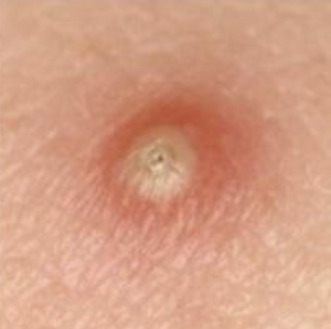 <p>variously sized circumscribed elevations containing pus </p>