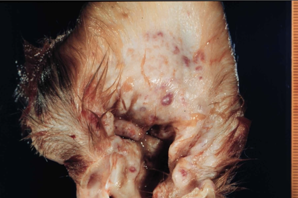 <p><strong>Inflammation of the external acoustic meatus. </strong>The EAM is dermatologic tissue lined by:</p><ul><li><p>Keratinized stratified squamous epithelium</p></li><li><p>Thin dermis</p></li><li><p>Sebaceous glands</p></li><li><p>Hair follicles</p></li><li><p>Ceruminous glands, which are more abundant medially than laterally</p></li></ul><p></p>