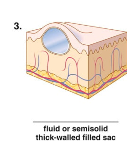 <p>fluid or semisolid thick walled filled sac</p>
