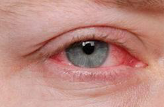 <p>+ eye redness</p><p>+ swollen lymph hnondes near the ear</p>