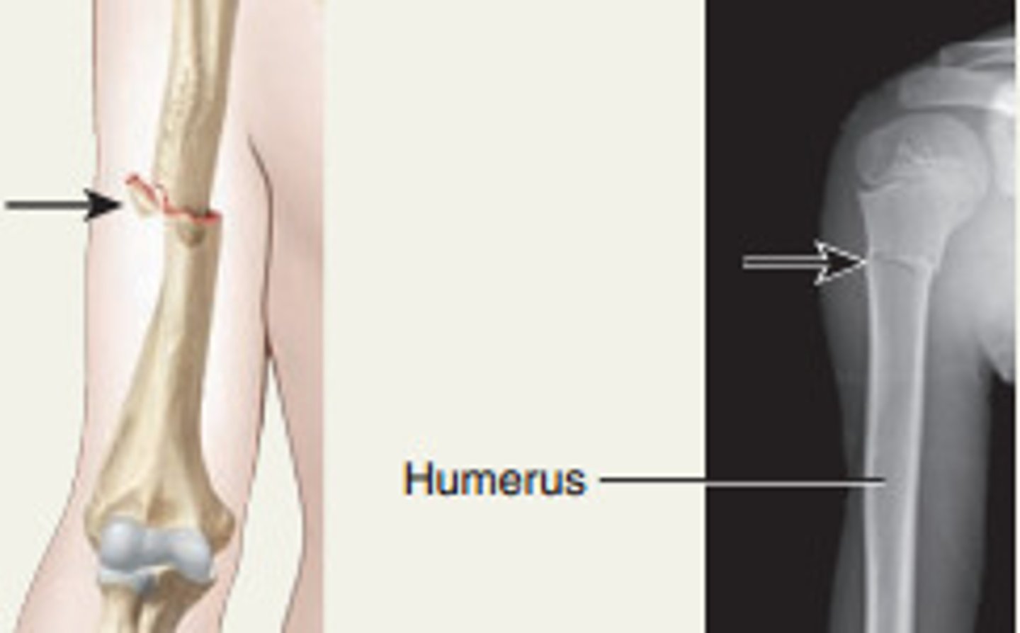 <p>Bone ends jammed into each other.</p>