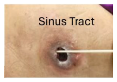 <p>Sinus tract (ex: tract at 5 o'clock 7 cm)</p>