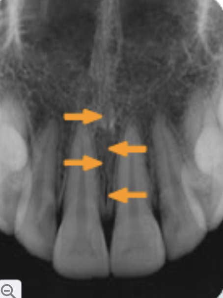 <p>median palatal suture</p>