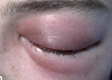 <ul><li><p>Active infection of diffuse tissue in-front of orbital septum</p></li><li><p>Signs:</p><ul><li><p>Warm</p></li><li><p>Tender</p></li><li><p>Painful to touch</p></li></ul></li></ul><p></p>
