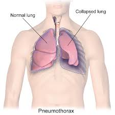 <p>A condition where air collects in the space around the lung, causing the lung to collapse partially or completely.</p>