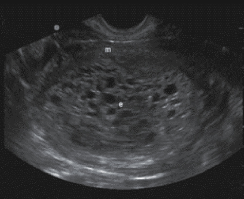 <p>14. In Figure 23-25, what adnexal finding is likely present?</p><p>a. Cystic teratoma</p><p>b. Theca lutein cyst</p><p>c. Ovarian torsion</p><p>d. Hydrosalpinx</p>