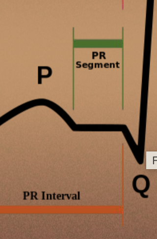 <p>PR interval</p>