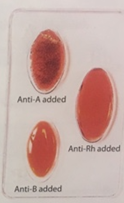 <p>What blood type is this sample?</p>