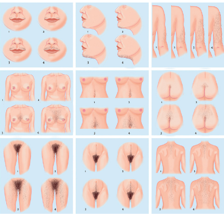 <p>excessive growth of coarse, dark hair in women on androgen-dependant areas (i.e. beard/chest); treatment depends on underlying cause often involves hormonal therapy or cosmetic solutions. </p>