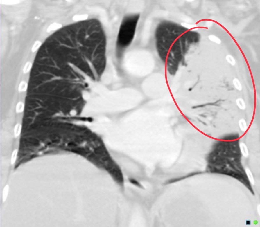 <p>What does this air bronchogram indicate for the pt</p>