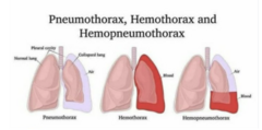 <p>explain what a pneumothorax, hemothorax, and hemopneumothorax is and what the S/S are, how to diagnose it,what the treatment is, and how lungs sounds would sound.</p>