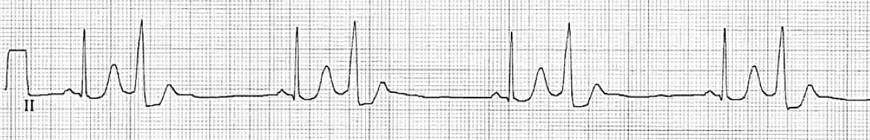 <p>What rhythm/abnormality is seen below?</p>