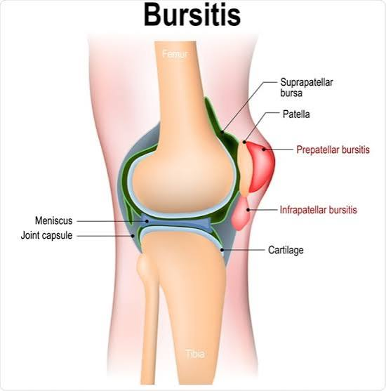 <p>inflammation of the bursa→synovial fluid buildup</p><p><u>due to</u></p><ul><li><p>overuse</p></li><li><p>trauma</p></li><li><p>rheumatoid arthritis</p></li></ul><p>common at joints that perform repetitive motion:<br>-shoulder<br>-elbow</p>